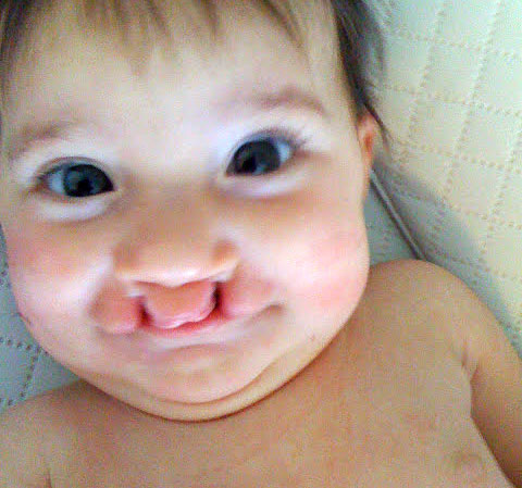 cleft lip